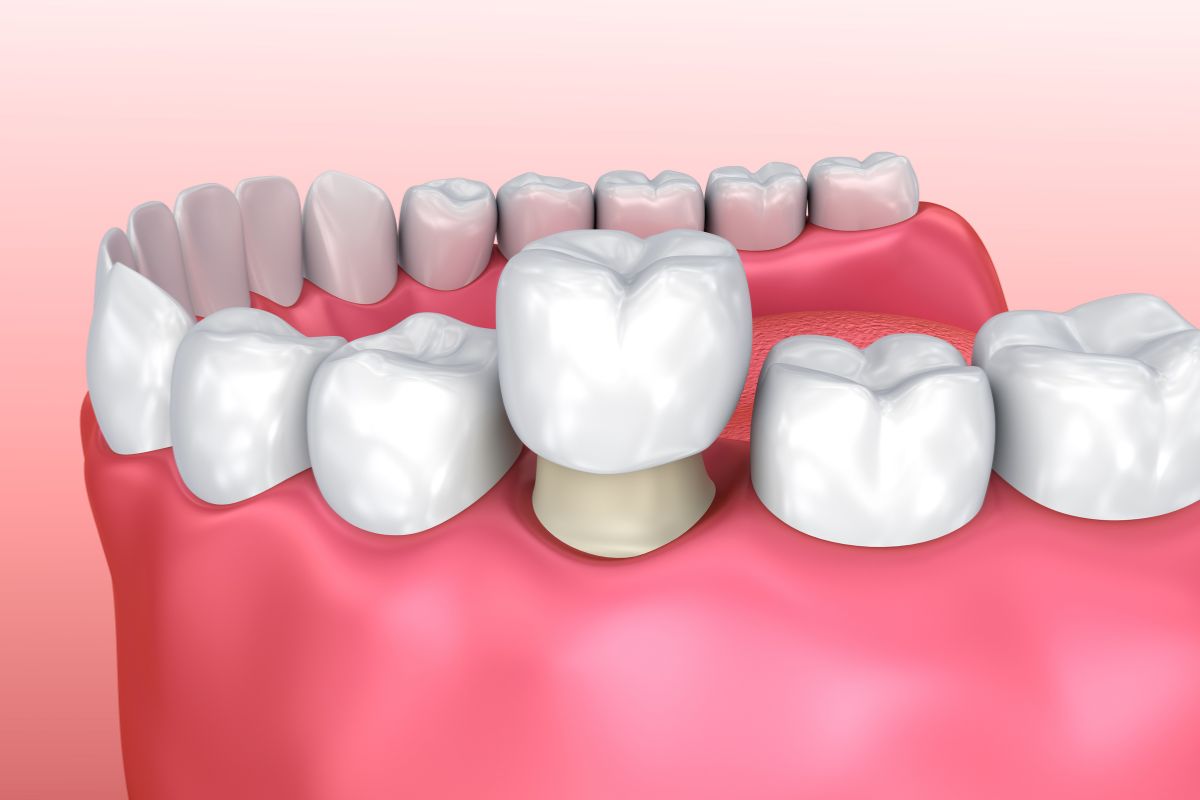 colocación de corona provisional