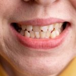 Movilidad dental en adultos: causas más allá de la periodontitis