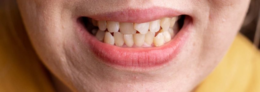 Movilidad dental en adultos mas allá de la periodontitis
