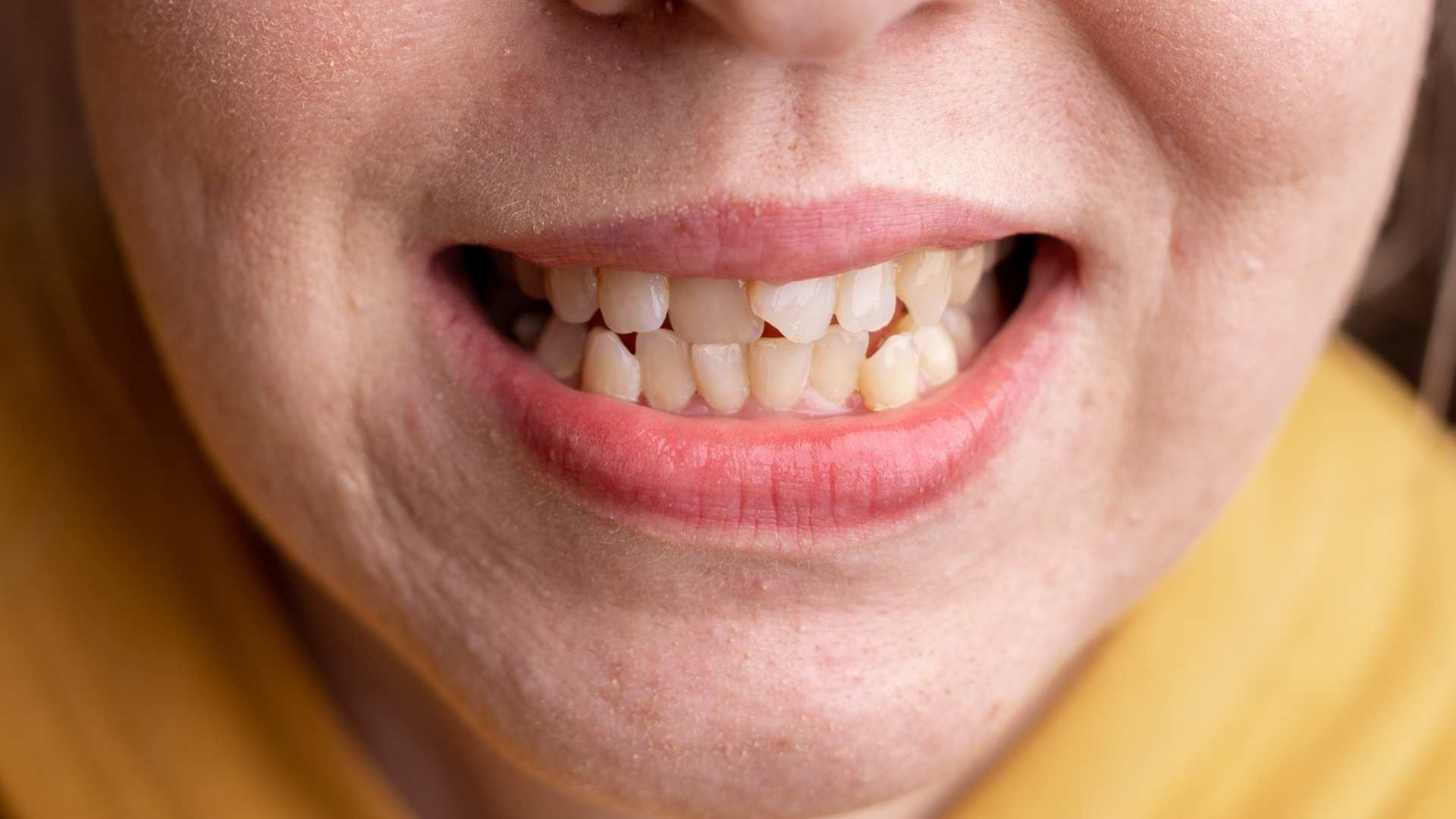 Movilidad dental en adultos mas allá de la periodontitis