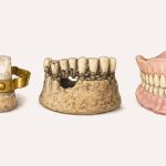 La evolución de las prótesis dentales a lo largo de la historia