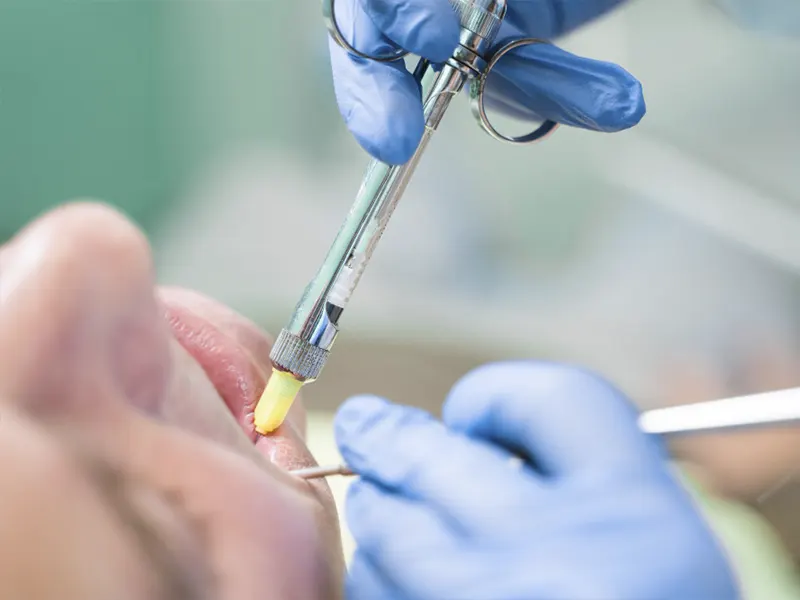 Anestesia local en el dentista